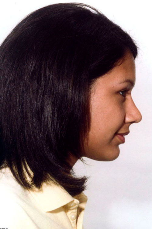 Rhinoplasty