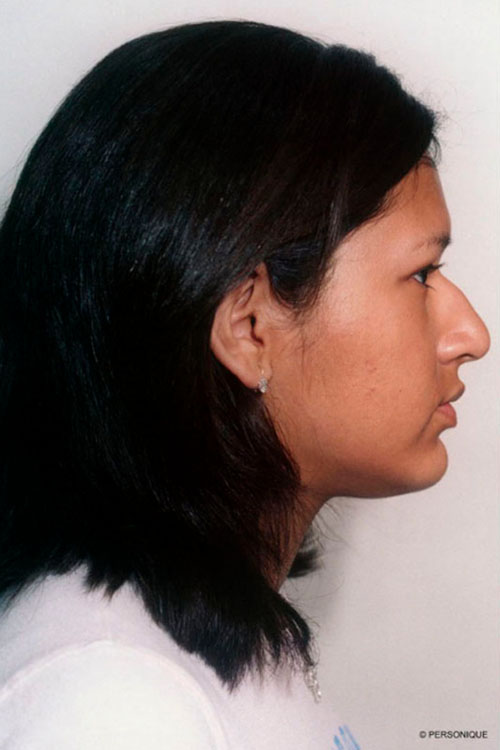 Rhinoplasty