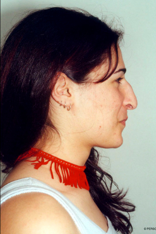 Rhinoplasty