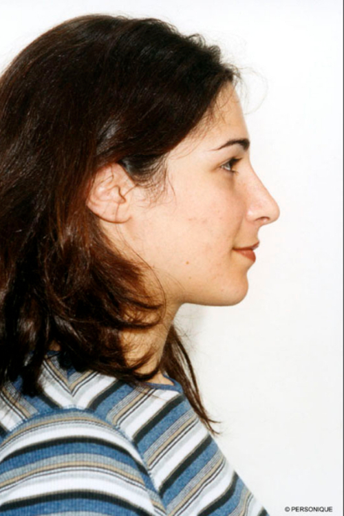 Rhinoplasty