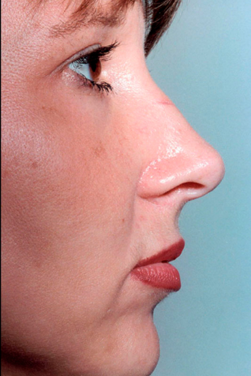 Rhinoplasty