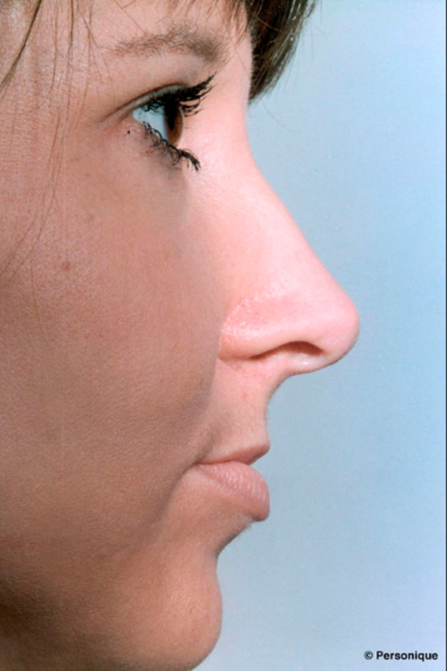 Rhinoplasty