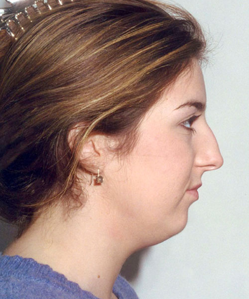 Rhinoplasty