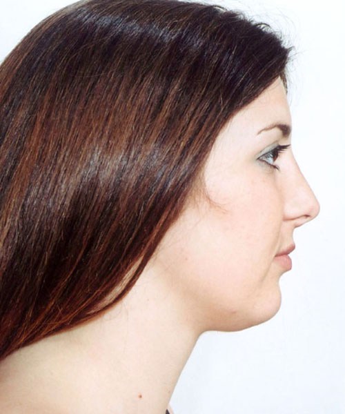 Rhinoplasty