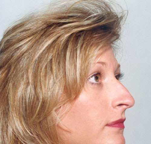 Rhinoplasty