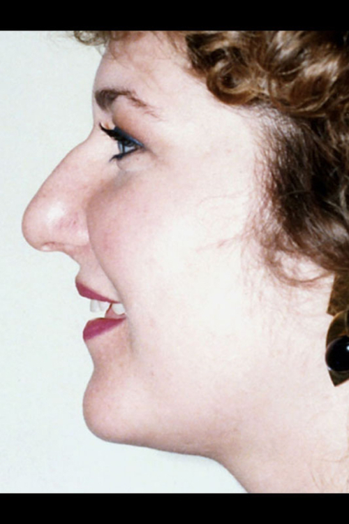 Real patient Rhinoplasty before photo