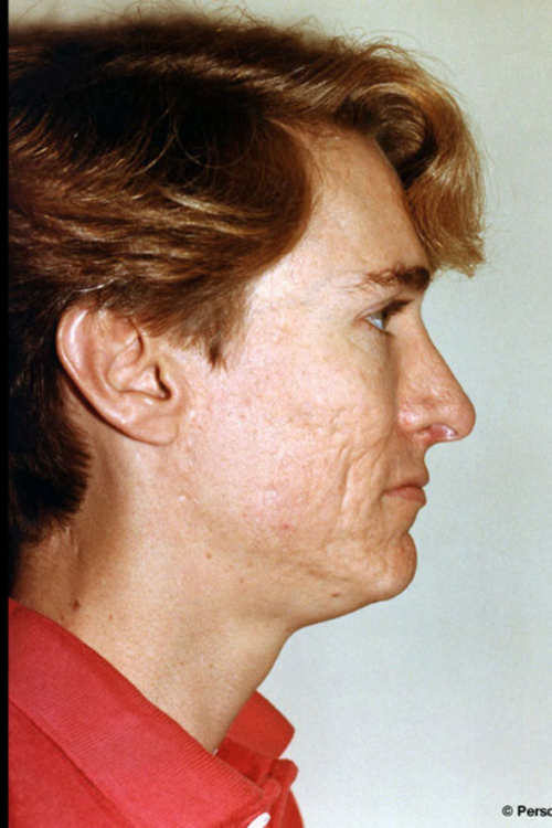 Rhinoplasty