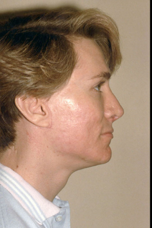 Rhinoplasty