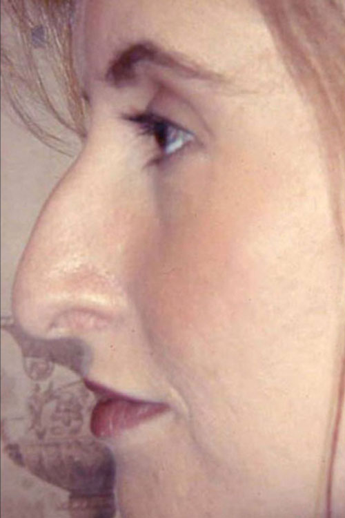 Rhinoplasty