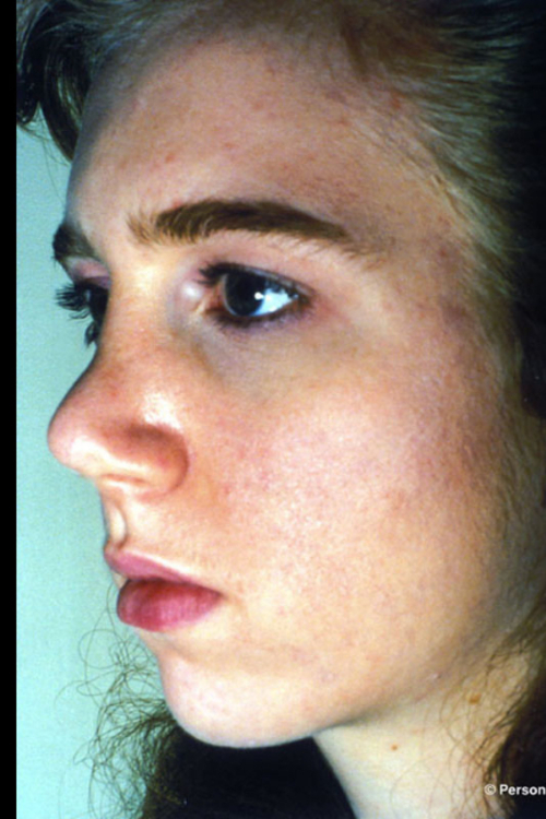 Rhinoplasty