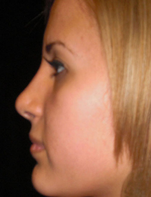 Rhinoplasty