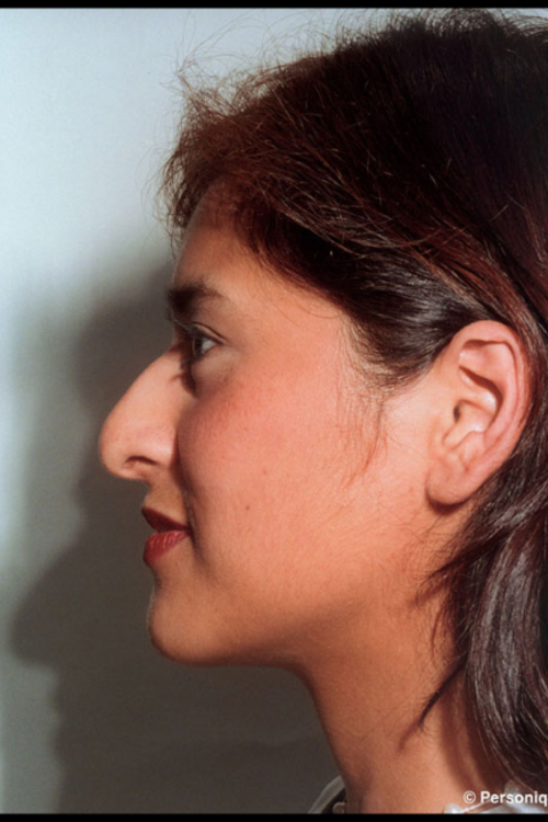 Rhinoplasty