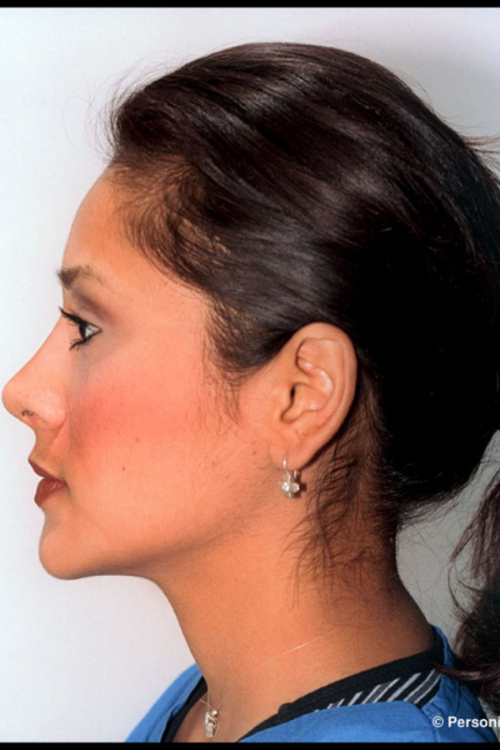 Rhinoplasty