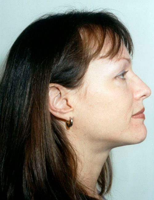 Rhinoplasty