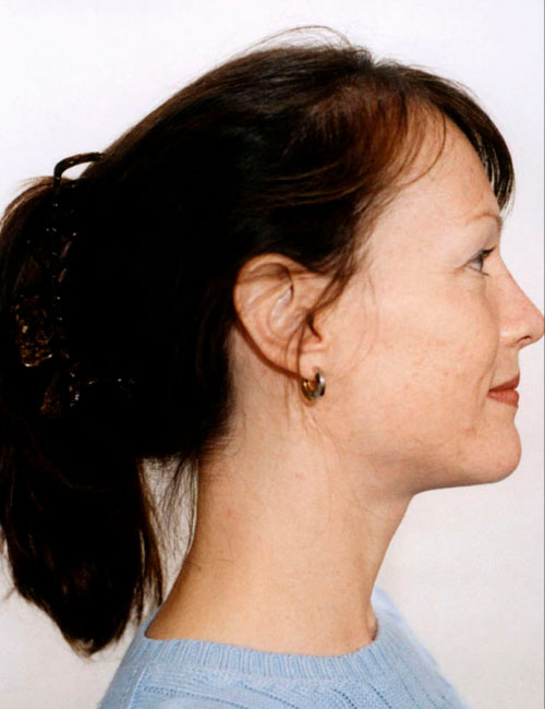 Rhinoplasty