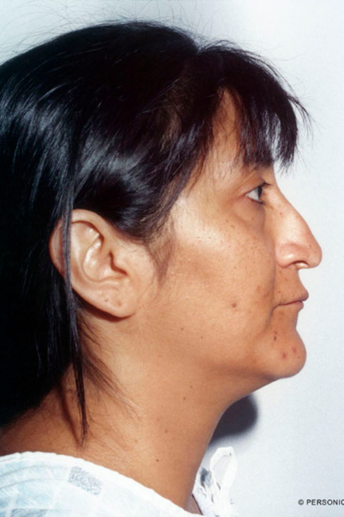 Rhinoplasty