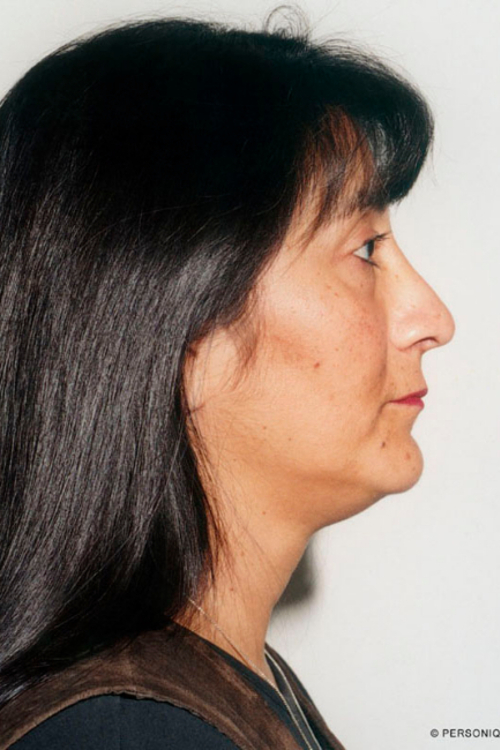 Rhinoplasty