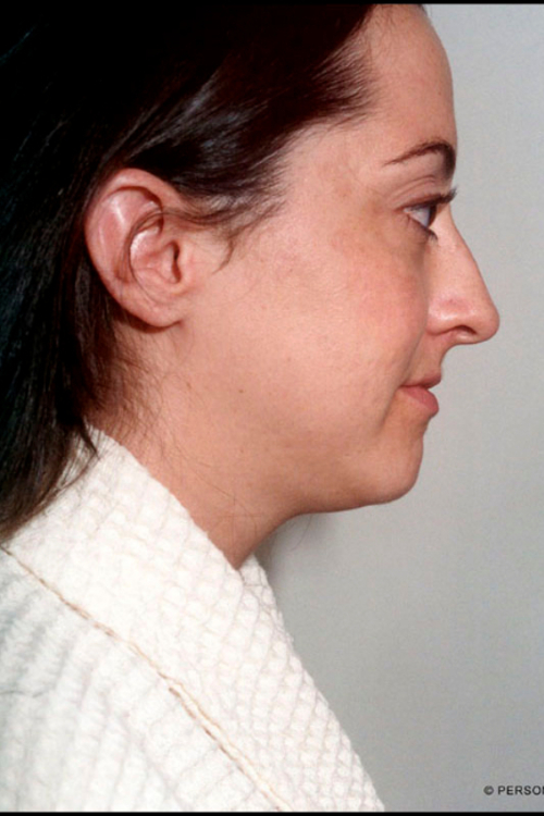 Rhinoplasty