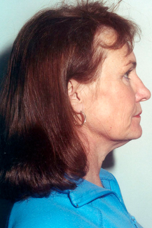 Rhinoplasty