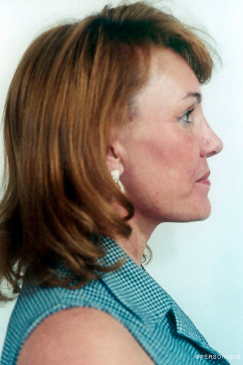 Rhinoplasty