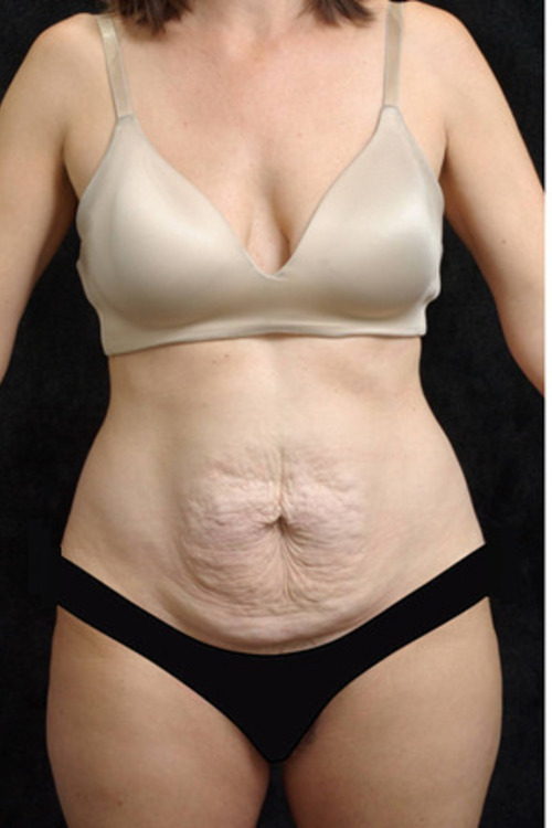 Tummy Tuck